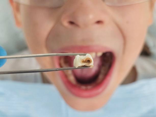 Best Tooth Infection Emergency Dentist  in Mims, FL